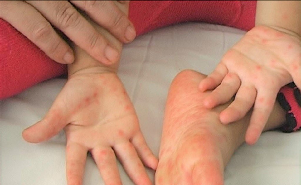 Số ca mắc tăng cao, Bộ Y tế yêu cầu siết chặt phòng chống dịch tay chân miệng